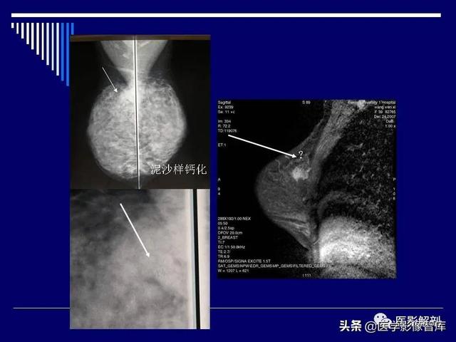 乳房解剖学基础知识，乳腺解剖及乳腺各病变影像诊断与鉴别