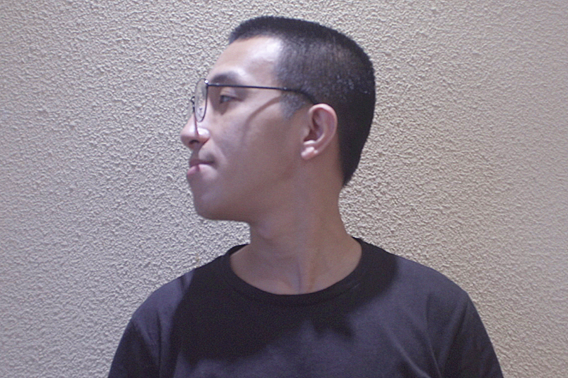 正颌手术失败案例（被骨性地包天困扰多年）