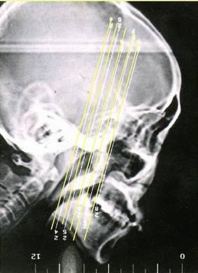 鼻窦炎微创手术，鼻窦炎微创手术价格是多少（诊治及【合理用药）