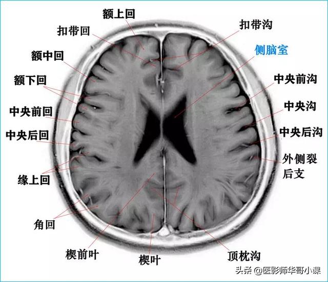 头颅ct解剖图，头部骨骼结构图（颅脑磁共振MRI解剖结构以及高清图谱）