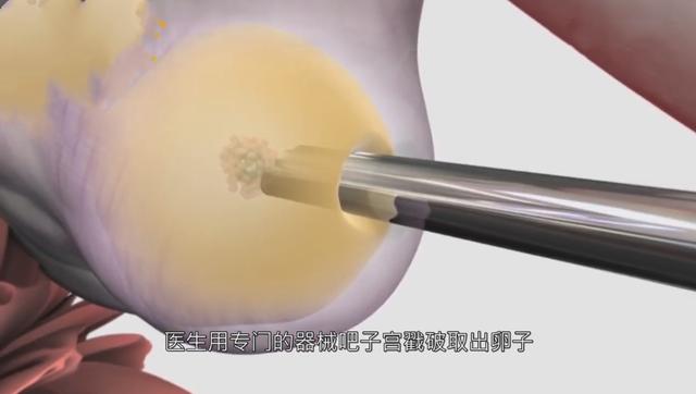 做试管婴儿痛苦吗,女人做试管婴儿痛苦吗(5张图为你“播放”整个过程) 做试管婴儿痛苦吗,女人做试管婴儿痛苦吗(5张图为你“播放”整个过程)