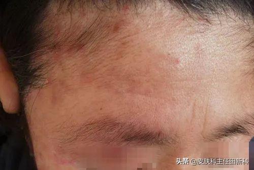 手上皮癣早期症状图片，皮癣的真实图片（你脸上成片“痘印”）