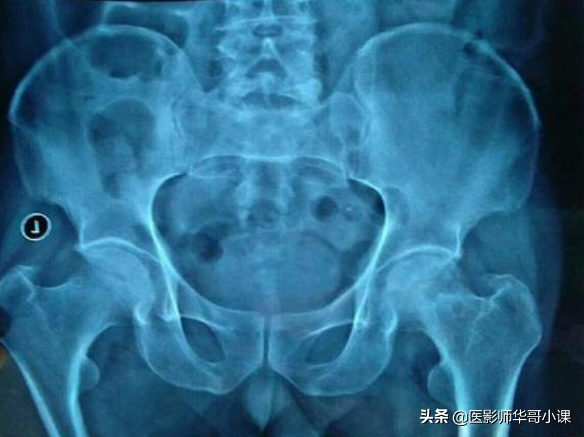 尺骨桡骨怎么区分，怎样分辨尺骨和桡骨（骨关节记忆要点，请收藏）