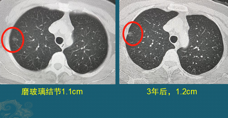 病例2,中心型肺鱗癌