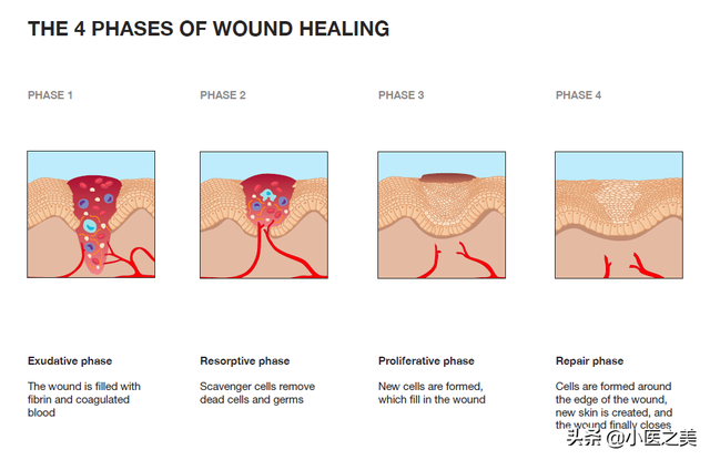 深二度烧伤恢复全部过程，以正确的方式治疗可帮助减轻疤痕增生
