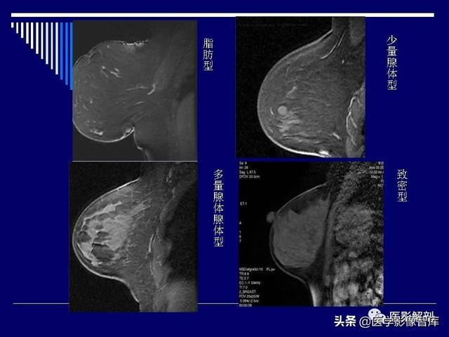 乳房解剖学基础知识，乳腺解剖及乳腺各病变影像诊断与鉴别