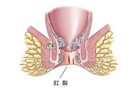 肛门胀疼是痔疮吗(肛门胀痛)