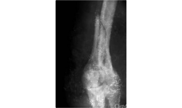 肱骨长是什么意思，骨科常见疾病X线解析之肱骨内髁骨折
