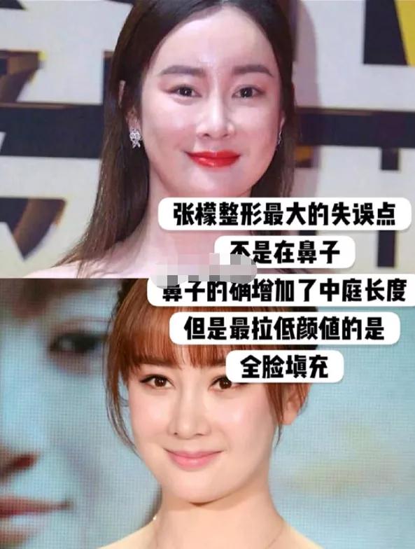 张檬颜值回春,取出鼻子假体后,面部肿胀消失,曾自曝后悔整容