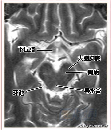 颅脑mri(头部MRI)插图(14)