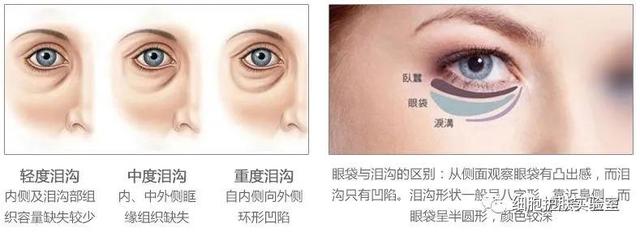泥奏凯是什么意思，皱纹小百科-泪沟，泥奏凯