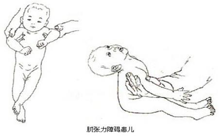 6个月宝宝肌张力高的表现图，宝宝肌张力高的3大表现（宝宝肌张力高的原因有哪些）