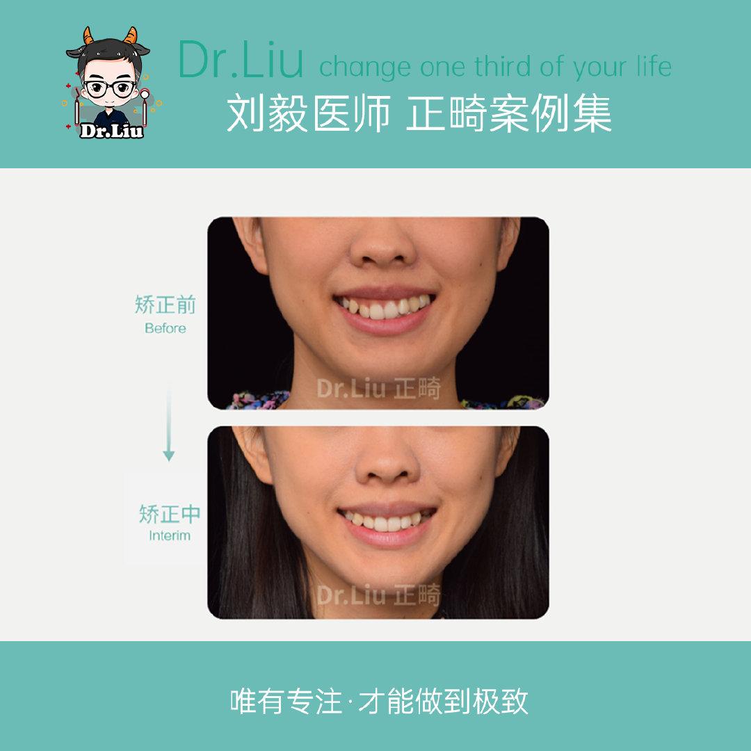 牙齿矫正案例（厦门牙齿矫正刘毅医生）