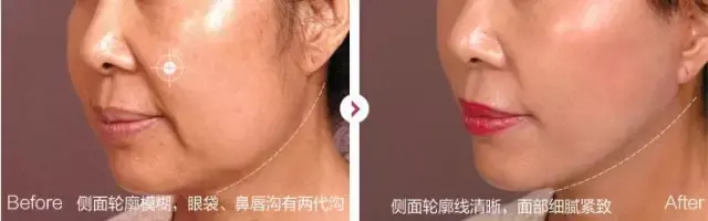超声波治疗仪的作用与效果，超声波治疗仪应用及功能作用（突然变老的皮肤“超声刀”有效果吗）