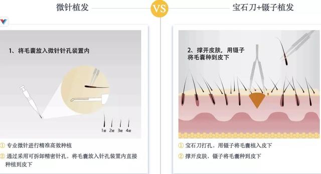 科发源毛发种植，科发源微针植发全科普（植发市场“供大于求”怎解）