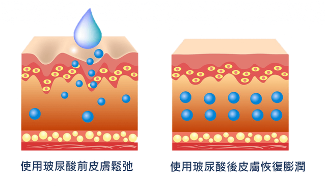 什么是玻尿酸，什么是玻尿酸天丝（你应该知道的玻尿酸常识）