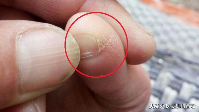 小脚趾甲两瓣是什么原因，为什么很多中国人小脚趾甲是两瓣的（很多中国人的小脚趾）