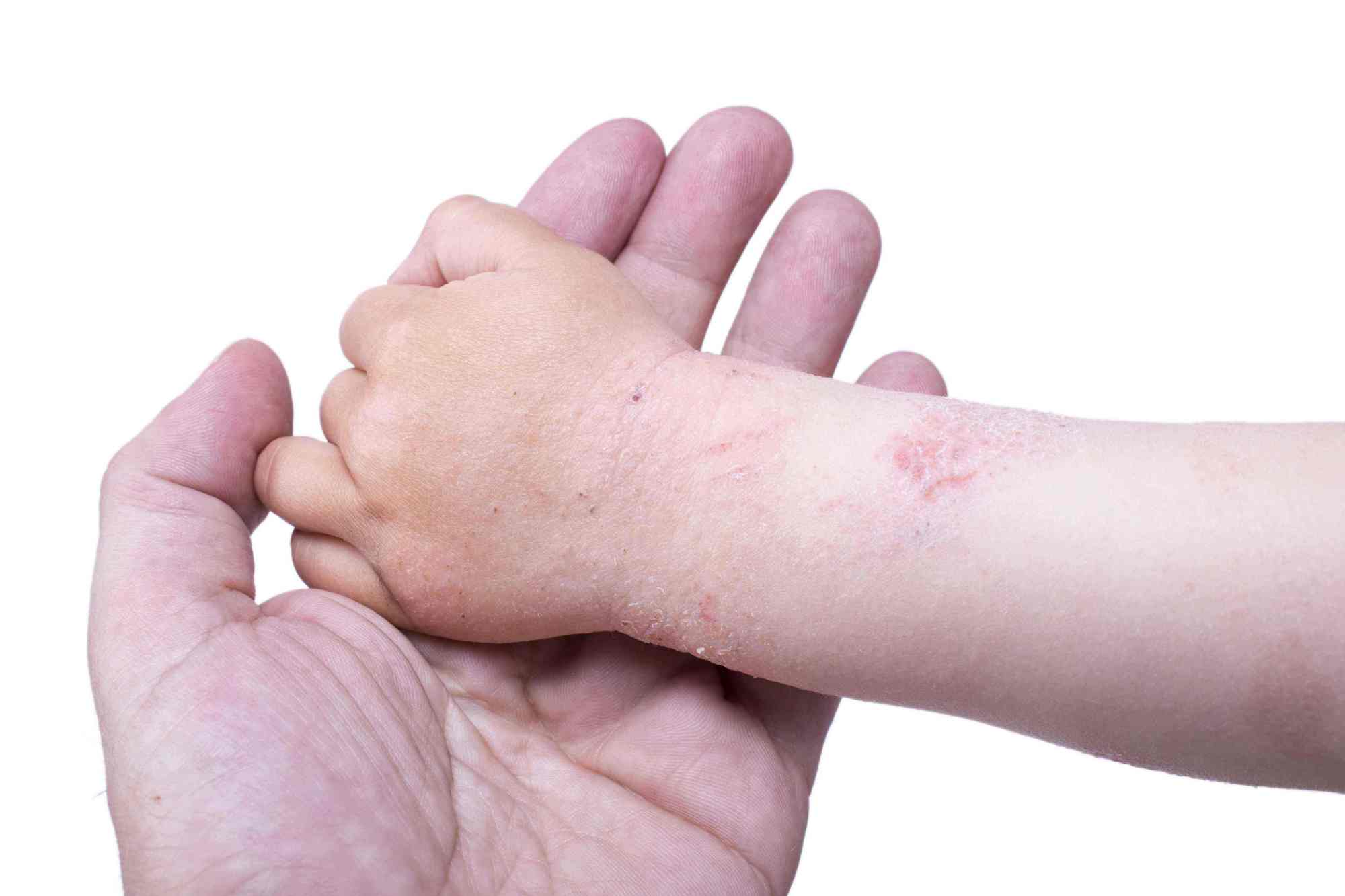 儿童冬季干性湿疹图图片