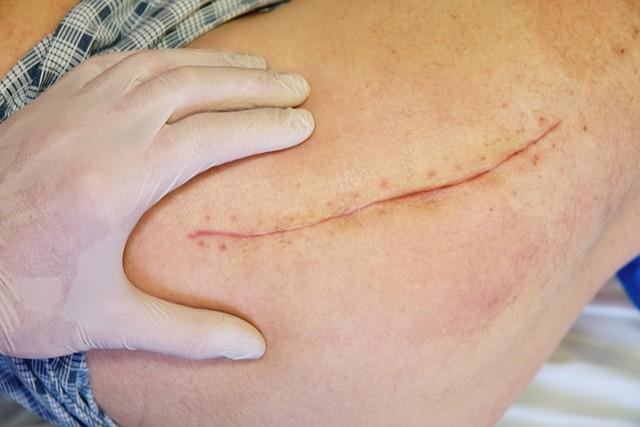 常用去除疤痕手术的优缺点，常用去除疤痕手术的优缺点有哪些（手术可以祛疤吗--手术祛疤效果好不好）