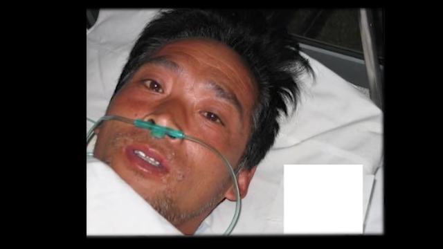 大内久83天活体腐烂图片，大内久83天活体腐烂是什么（大内久与核辐射战斗了83天）