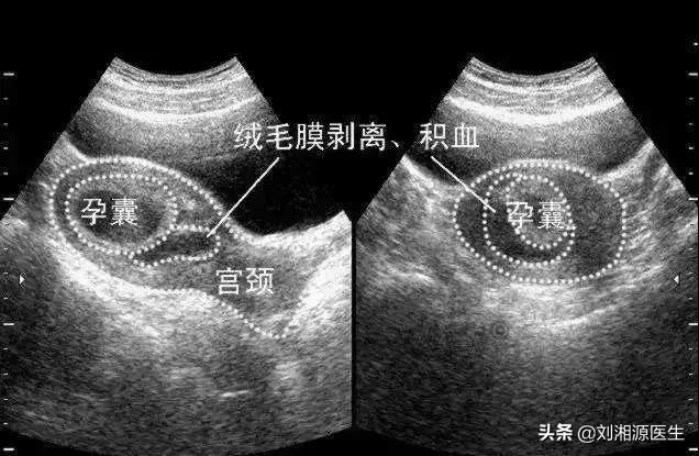 孕妇尿液发红但是擦了没有血，孕妇尿液发红但是擦了没有血有没有可能是感冒引起的（——孕期阴道出血）