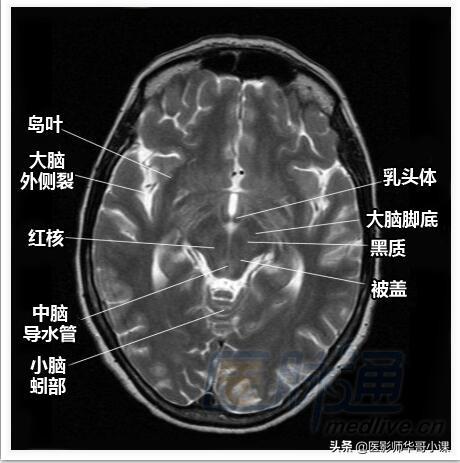 颅脑mri(头部MRI)插图(7)