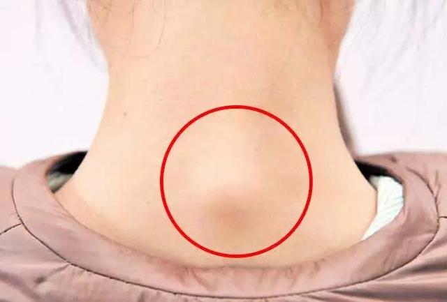 富贵包切除手术恢复需要多久 得了富贵包有必要去医院做手术吗，富贵包切除手术恢复需要多久（富贵包并不是富贵病）