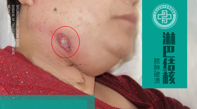 淋巴结核怎么治疗，淋巴结可以治疗吗（常见的好发部位和治疗方法是什么）