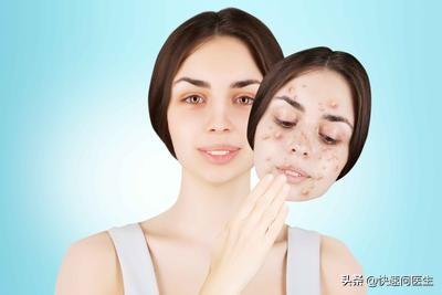 用激光去痘印好吗，激光去痘印好嘛（你知道这五个方法嘛）