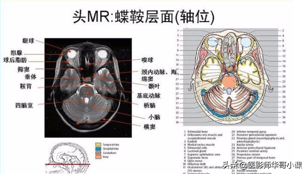 颅脑mri(头部MRI)插图(77)