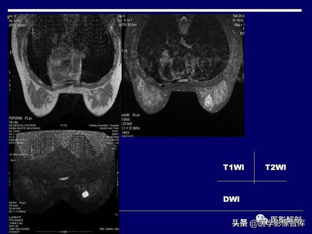 乳房解剖学基础知识，乳腺解剖及乳腺各病变影像诊断与鉴别