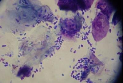 普通白斑图片大全，普通白斑图片及原因（不是所有的白斑都是白癜风）