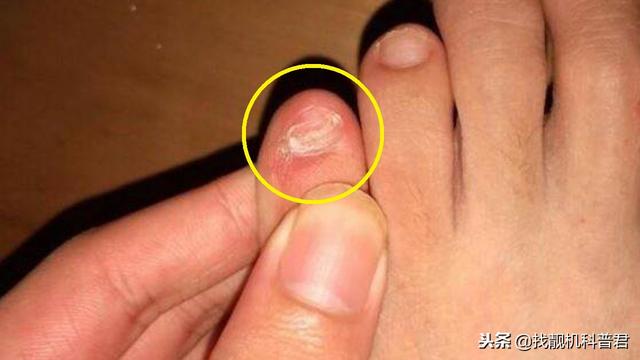 小脚趾甲两瓣是什么原因，为什么很多中国人小脚趾甲是两瓣的（很多中国人的小脚趾）