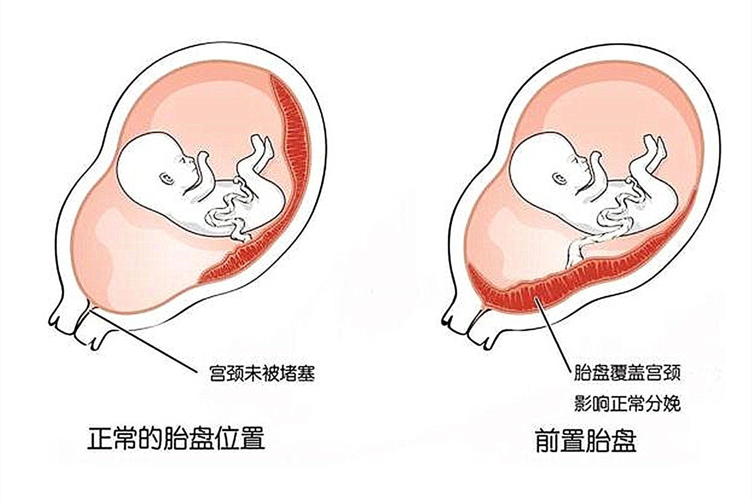 孕妇自身是否是胎盘前置,可以在检查中发现,记得在孕检的时候,多和