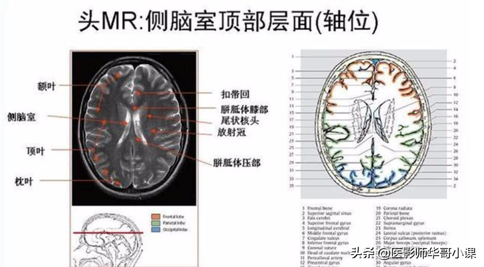 颅脑mri(头部MRI)插图(69)