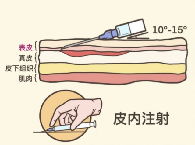 护士正确打针是怎么打的，平常看病打针，可是你知道吗