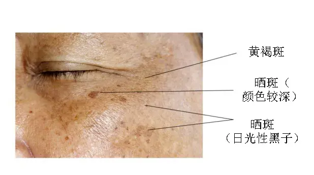 各种斑的区别图片，黄褐斑和雀斑区别图解（晒斑、肝斑、黄褐斑）