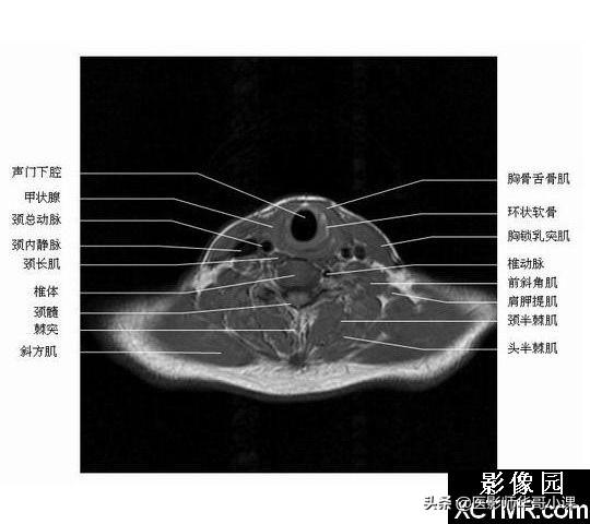 颅脑mri(头部MRI)插图(56)