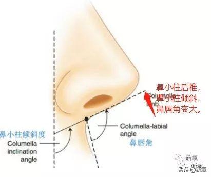 鼻翼收缩前后对比图，娜扎的鼻子怎么就歪掉了