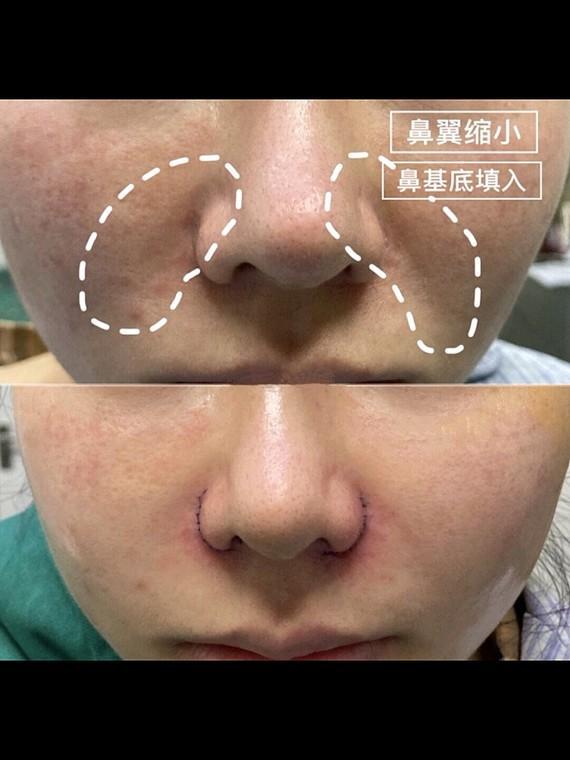 鼻基底填充原理，鼻基底填充的效果（注射填充好还是假体填充好）