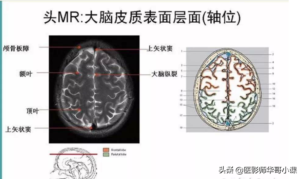 颅脑mri(头部MRI)插图(66)