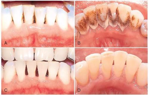 洗牙的好处和坏处,洗牙一次大概多少钱(一个职业口腔科医生帮你分析洗牙的利弊) 洗牙的好处和坏处,洗牙一次大概多少钱(一个职业口腔科医生帮你分析洗牙的利弊)