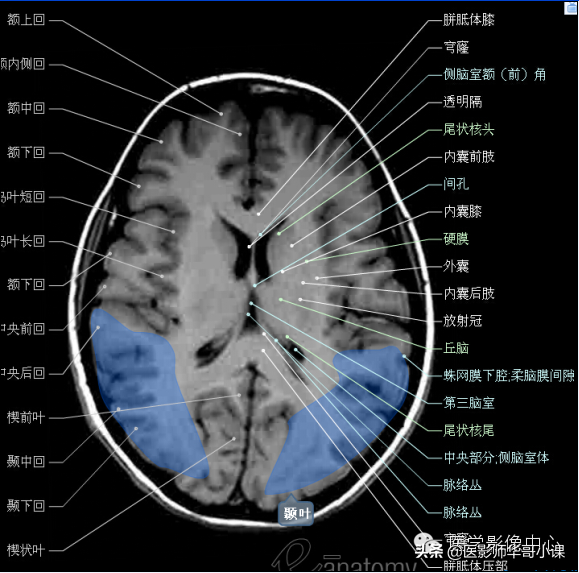 颅脑mri(头部MRI)插图(30)