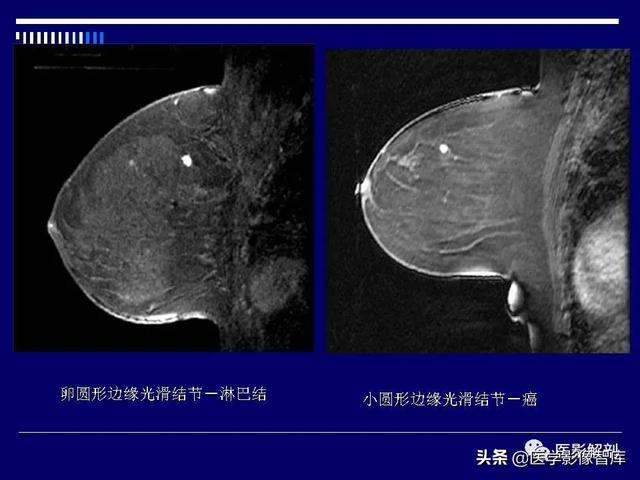 乳房解剖学基础知识，乳腺解剖及乳腺各病变影像诊断与鉴别