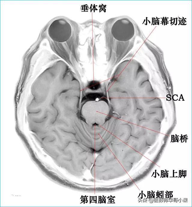 头颅ct解剖图，头部骨骼结构图（颅脑磁共振MRI解剖结构以及高清图谱）