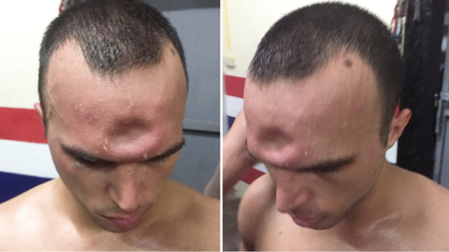 肘击有多大的威力，肘击怎样威力大（对方的头骨都可能会被干裂）
