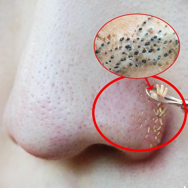 螨虫的克星是什么，螨虫的克星是什么硫磺皂吗（原来是厨房一物）