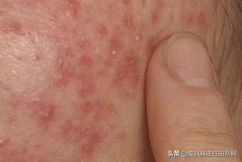 手上皮癣早期症状图片，皮癣的真实图片（你脸上成片“痘印”）