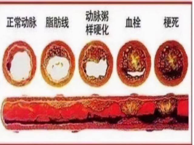 荷叶山楂陈皮泡水喝的功效，荷叶山楂膏喝了有什么功效（高血压病、高血脂症、脂肪肝）