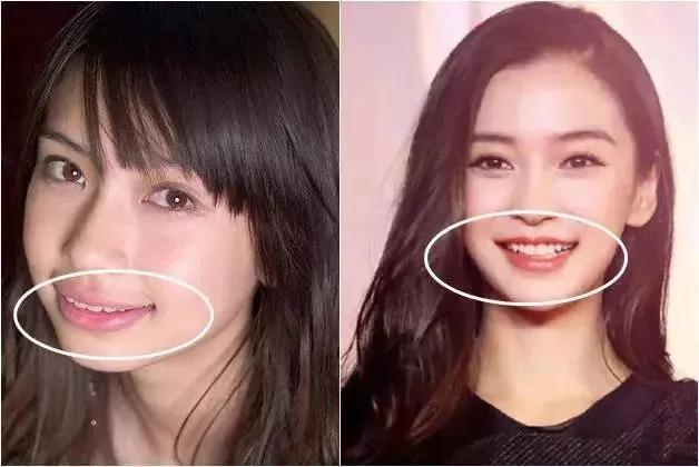 牙贴面前后案例（明星整牙前后的对比）